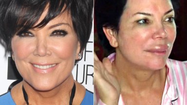 Kris Jenner Plastic Surgery Lips