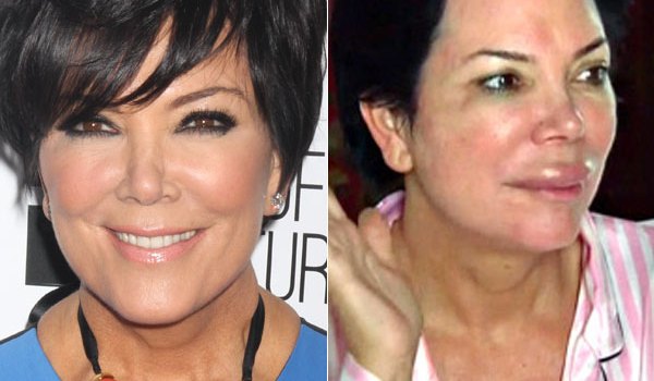 Kris Jenner Plastic Surgery Lips