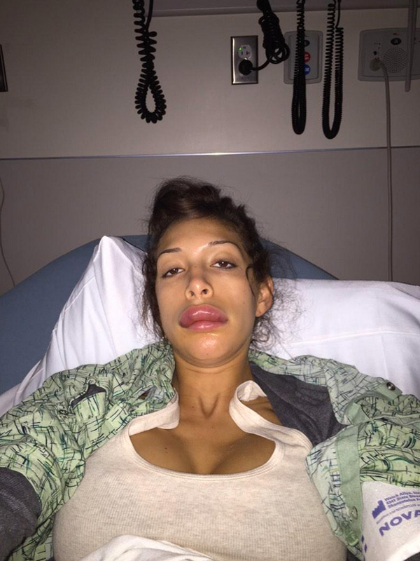 farrah-abraham-duck-lips-surgery-2