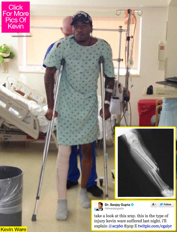 Kevin Ware X Ray
