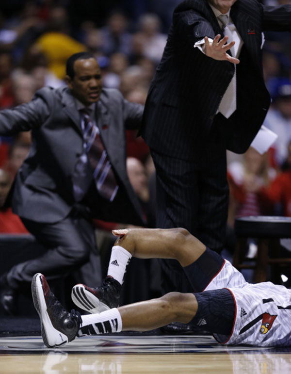 Kevin Ware Bone Pic