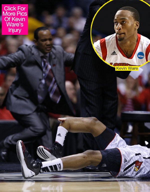 Kevin Ware Bone Pic