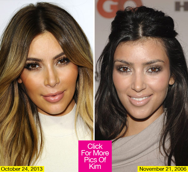 Kim Kardashian Botox