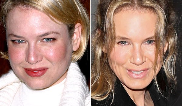 Renee Zellweger Plastic Surgery