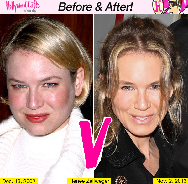 Renee Zellweger Plastic Surgery