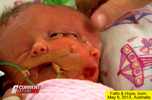 Australian Conjoined Twin Girls Die