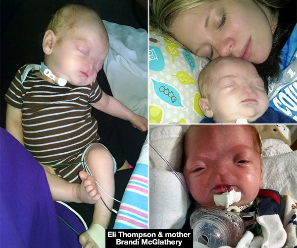 Baby Born Without Nose