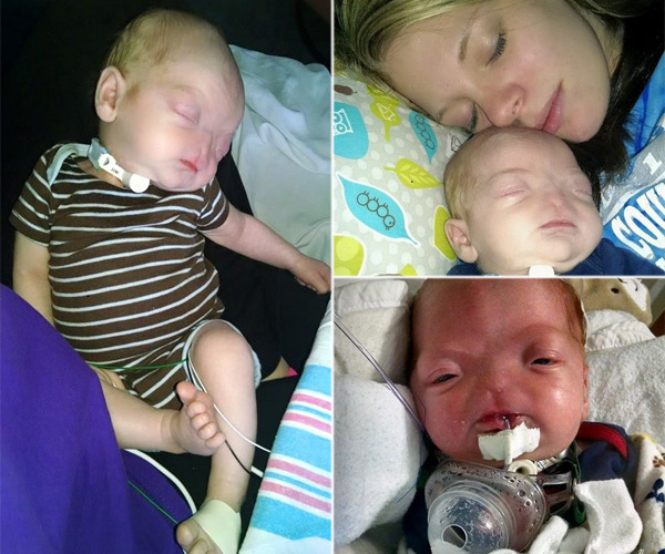 Baby Born Without Nose