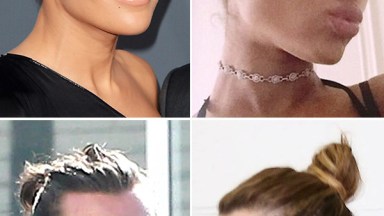 Traction Alopecia