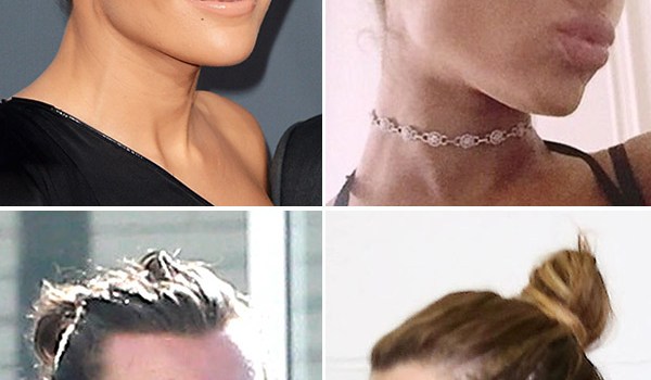 Traction Alopecia