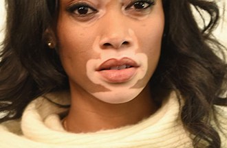 Winnie Harlow Celebrity Profile