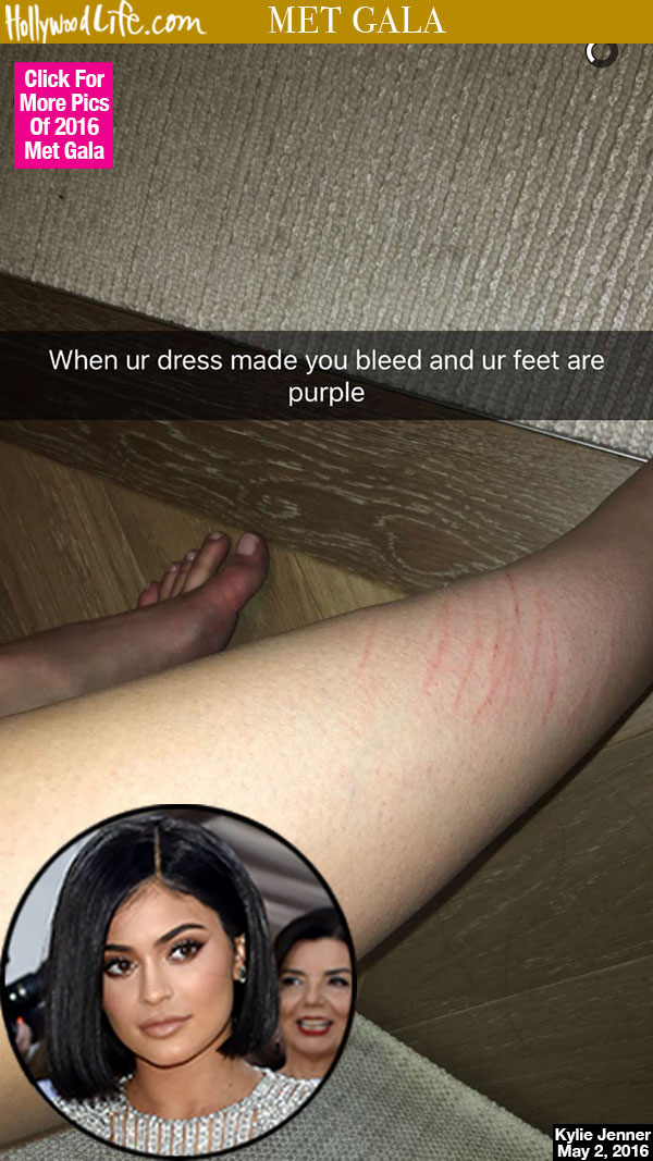 Kylie Jenner Feet Bleed Met Gala