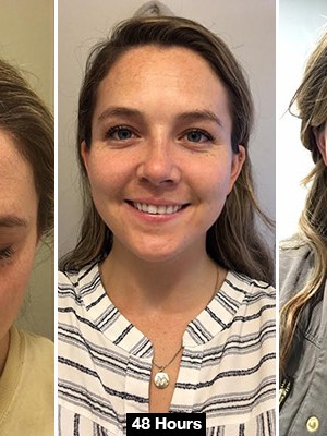 Botox In Your 20s