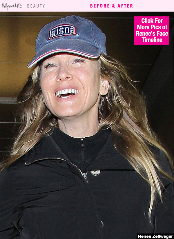 Renee Zellweger Lip Injections