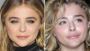 Chloe Moretz Lip Injections