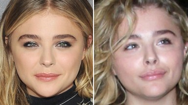 Chloe Moretz Lip Injections