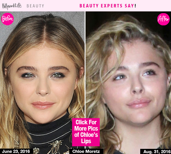 Chloe Moretz Lip Injections