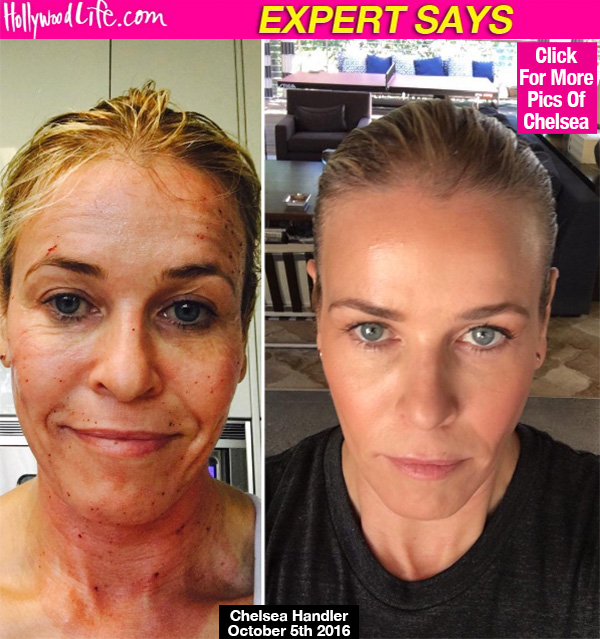 Chelsea Handler Anti Aging Treatment