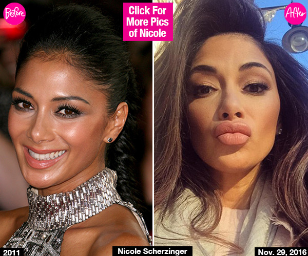 Nicole Scherzinger Lip Injections