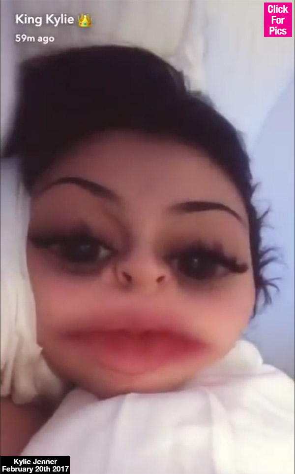 Kylie Jenner Lip fillers