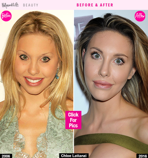 Chloe Lattanzi Plastic Surgery
