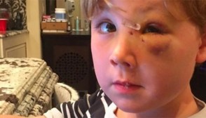 Kim Zolciak's son's dog bite