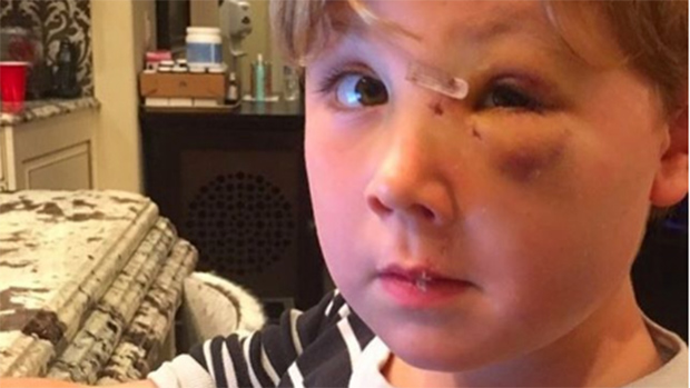 Kim Zolciak's son's dog bite