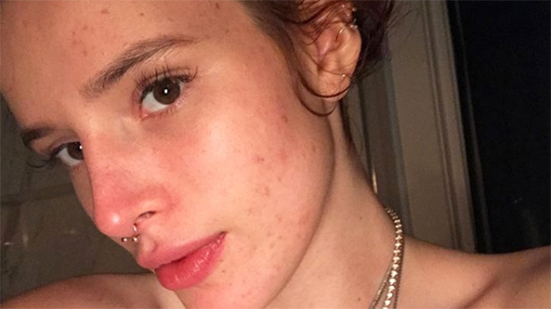 bella thorne acne