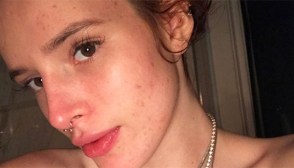 bella thorne acne
