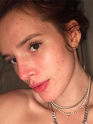 bella thorne acne