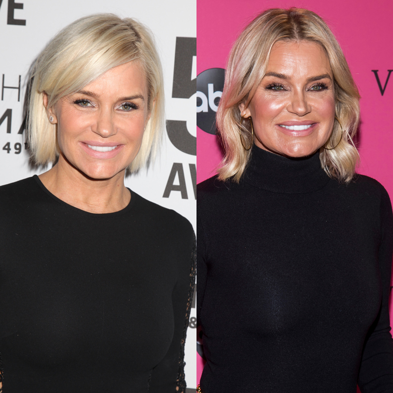 Yolanda Hadid Botox