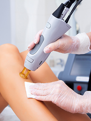 hair removal laser
