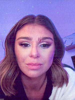 Raquel Leviss bruised face